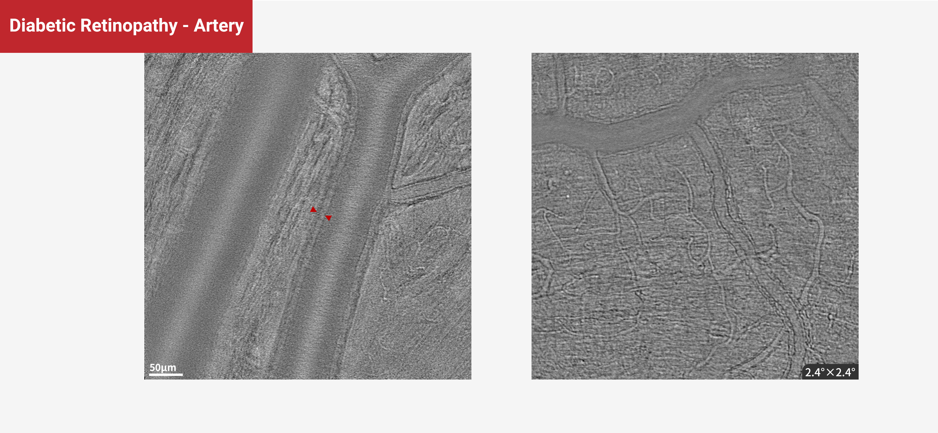 Diabetic Retinopathy - Artery