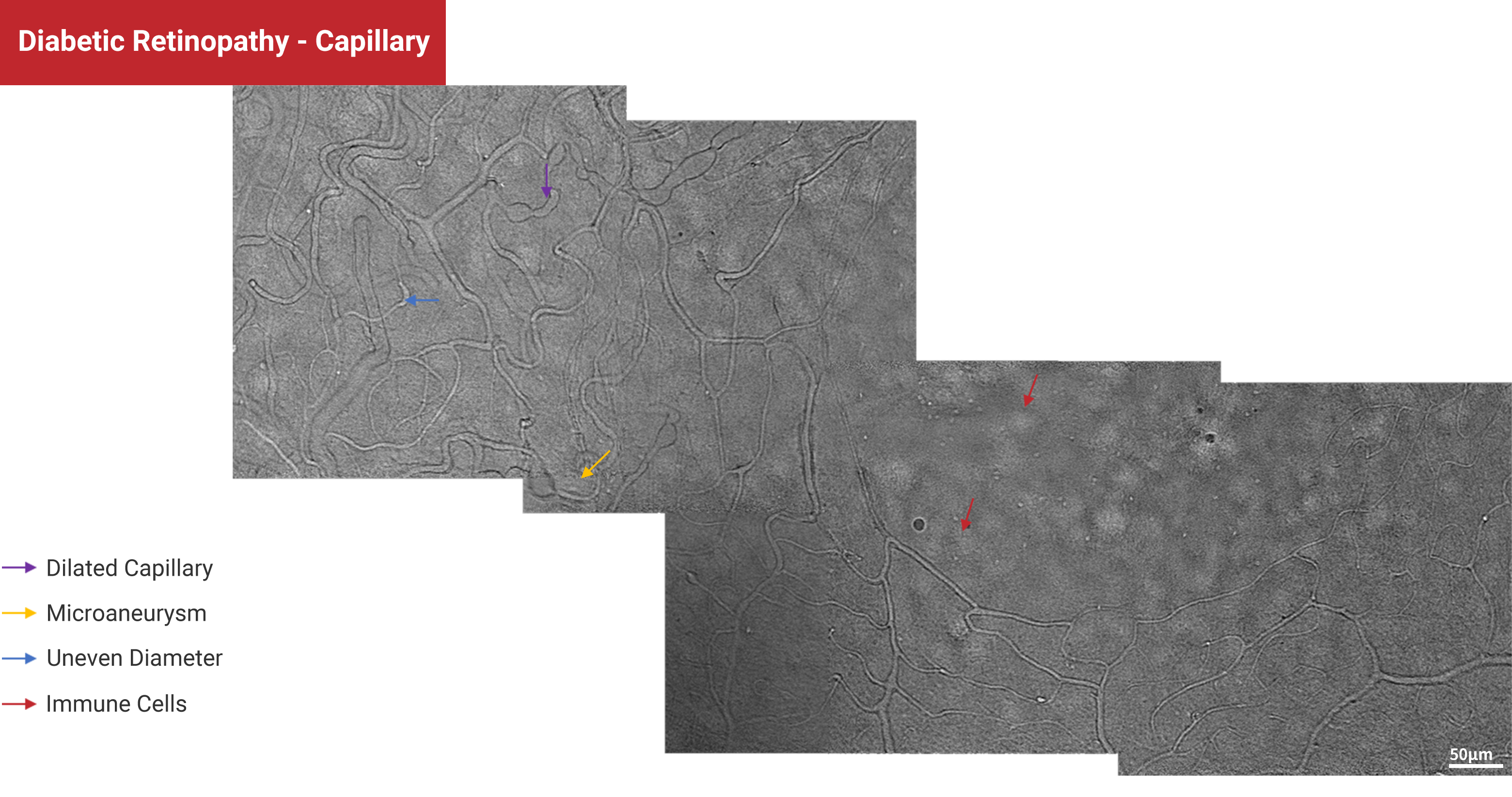 Diabetic Retinopathy - Capillary