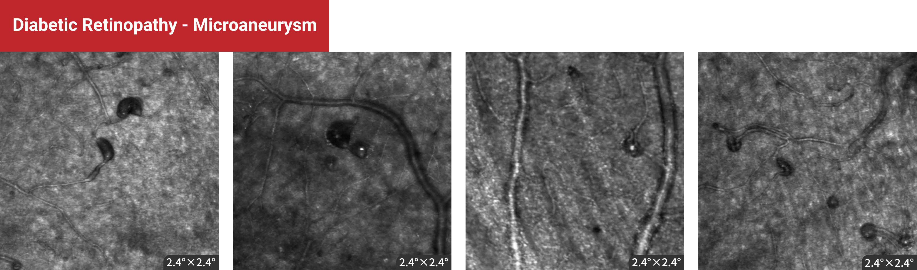 Diabetic Retinopathy - Microaneurysm