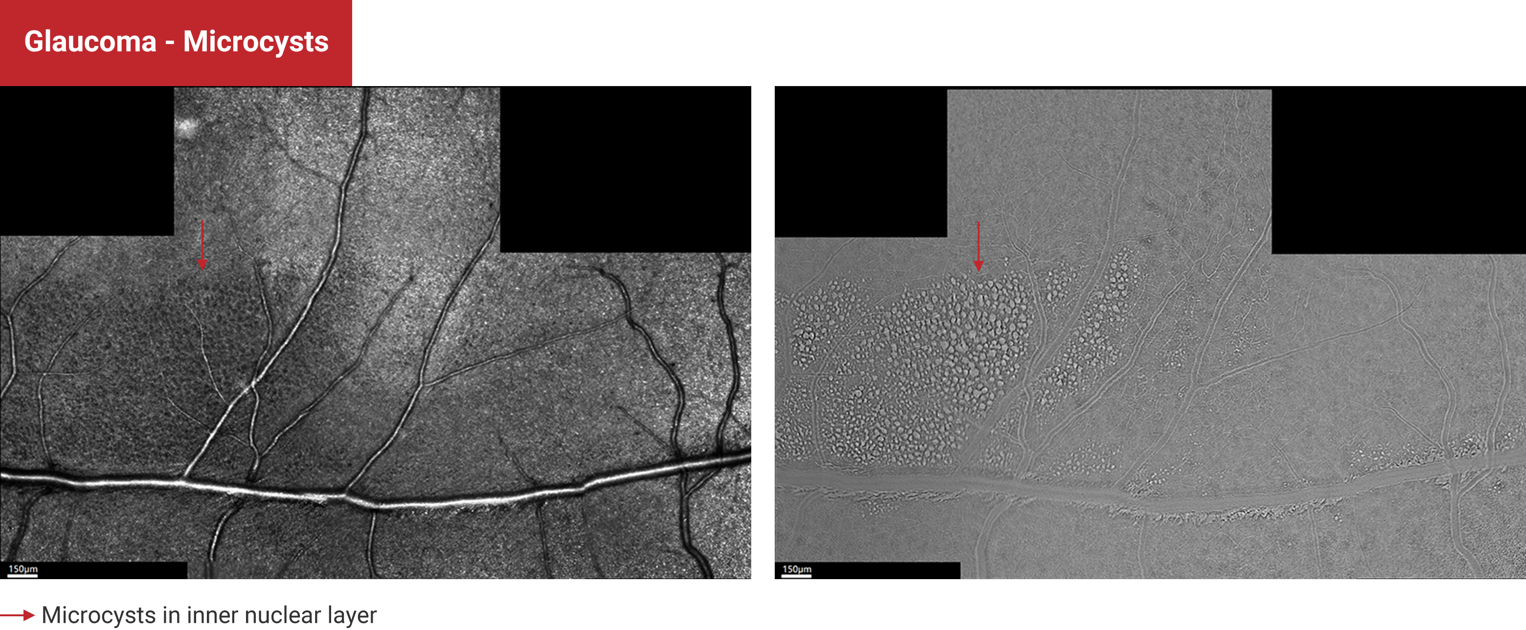 Glaucoma - Microcysts