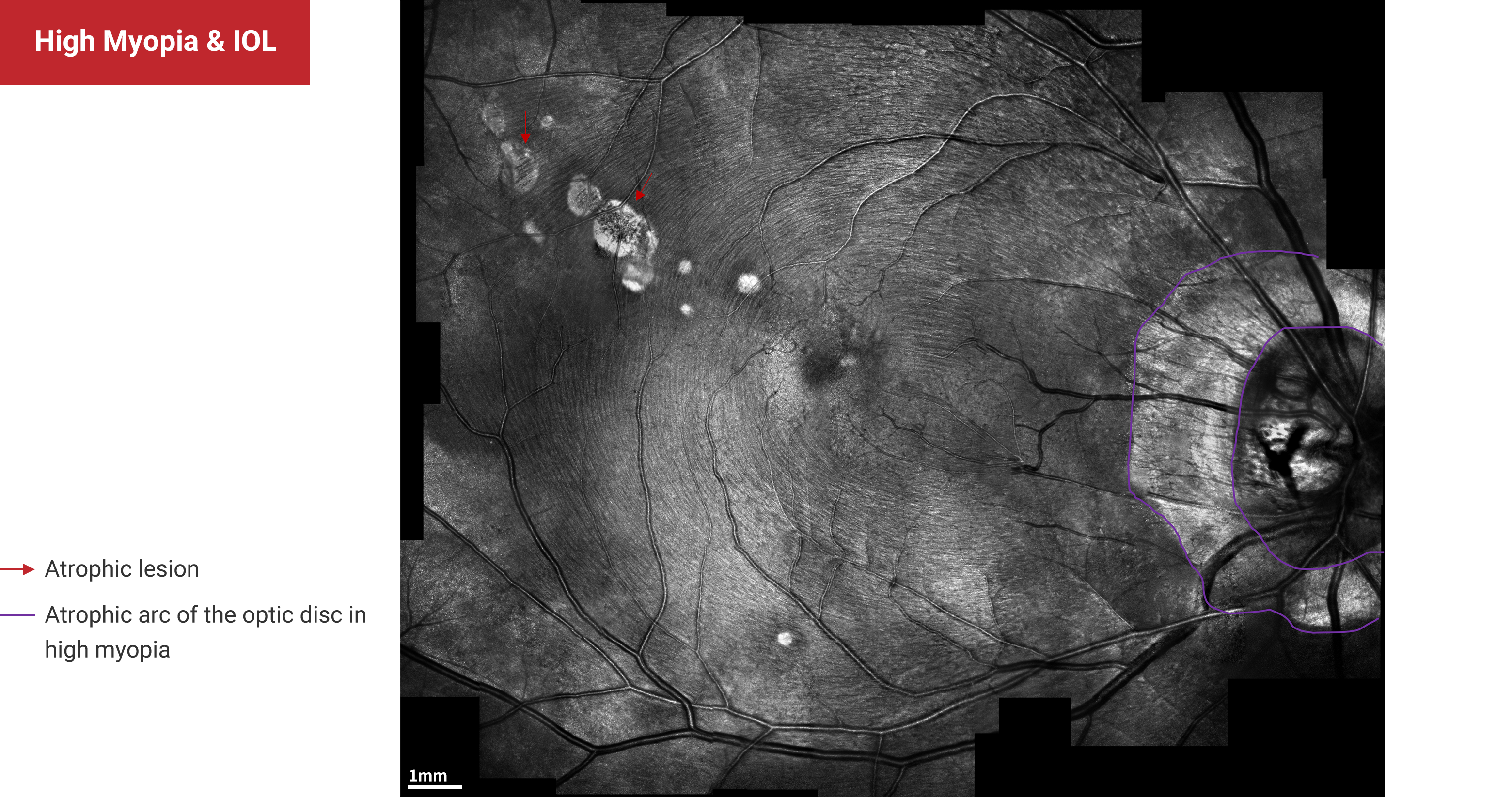 High Myopia & IOL