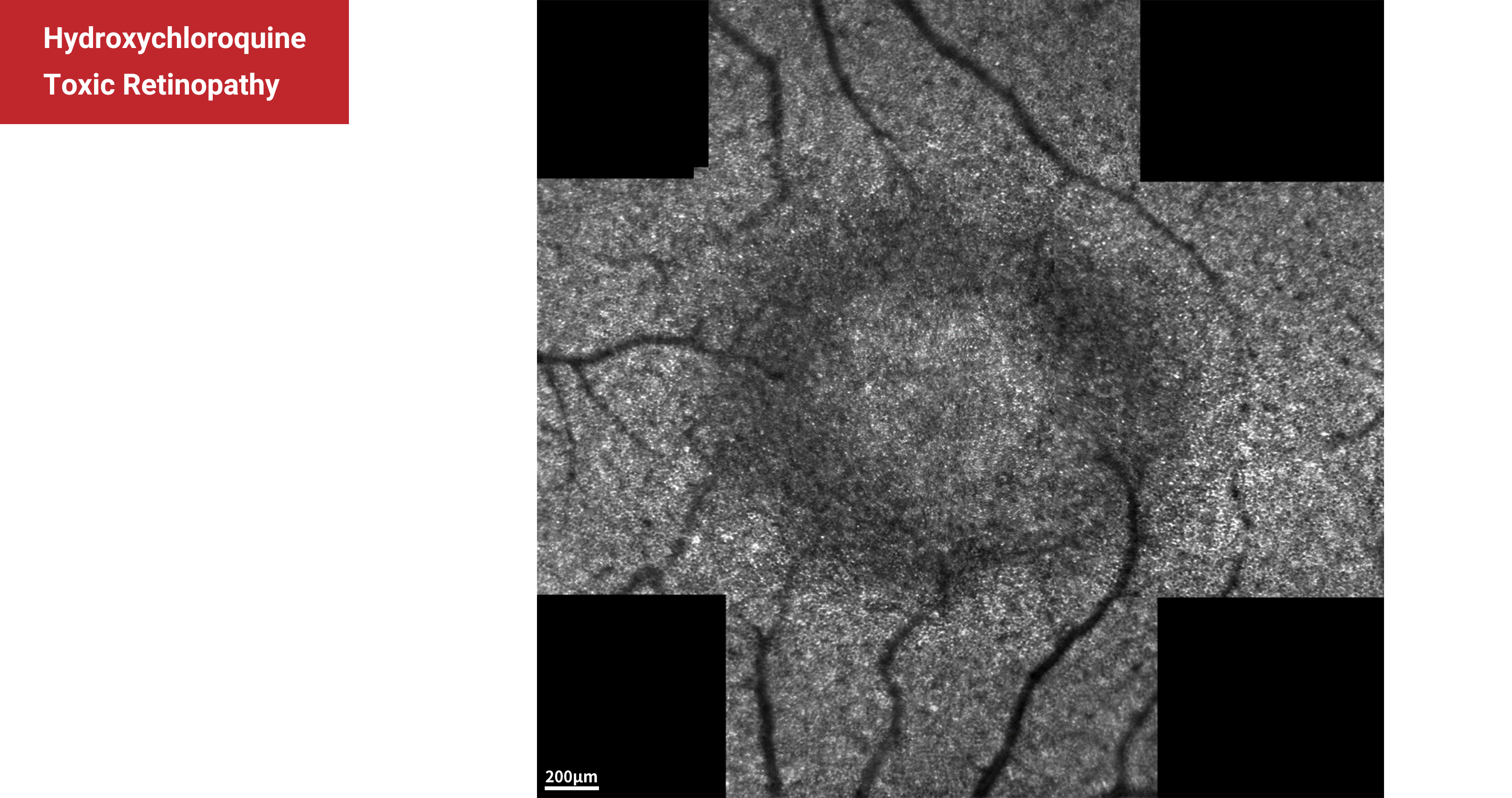 Hydroxychloroquine Toxic Retinopathy