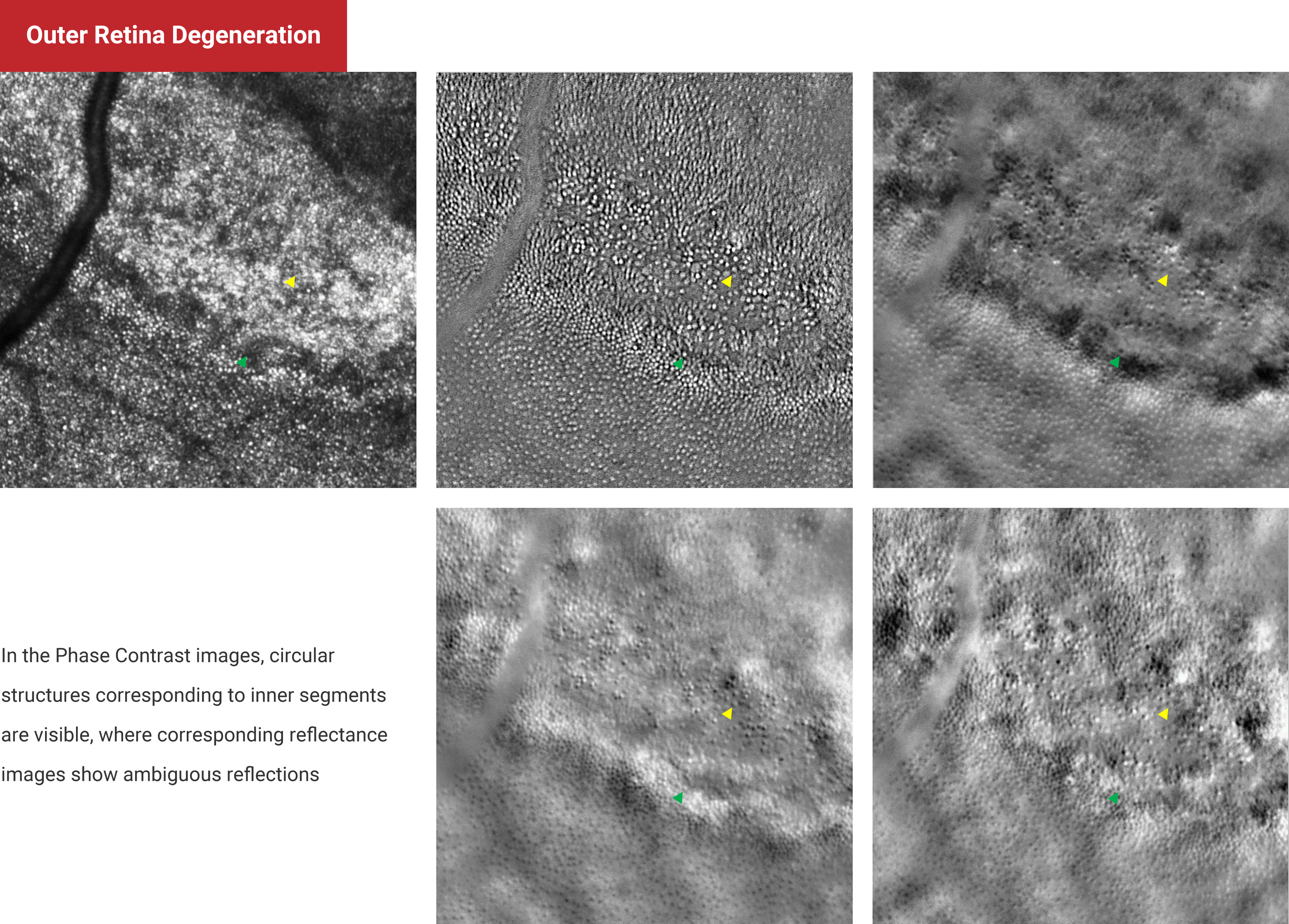 Outer Retina Degeneration