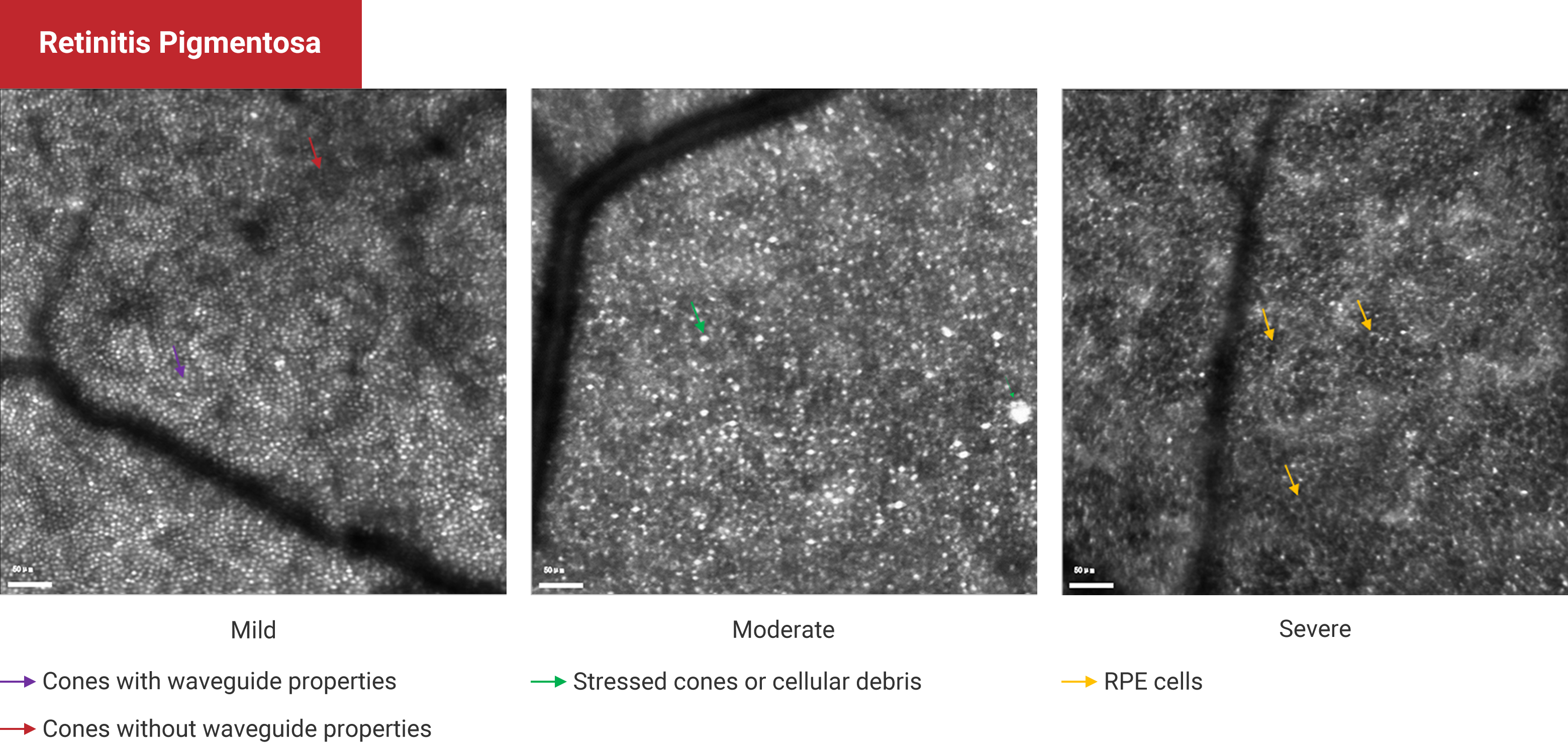 Retinitis Pigmentosa