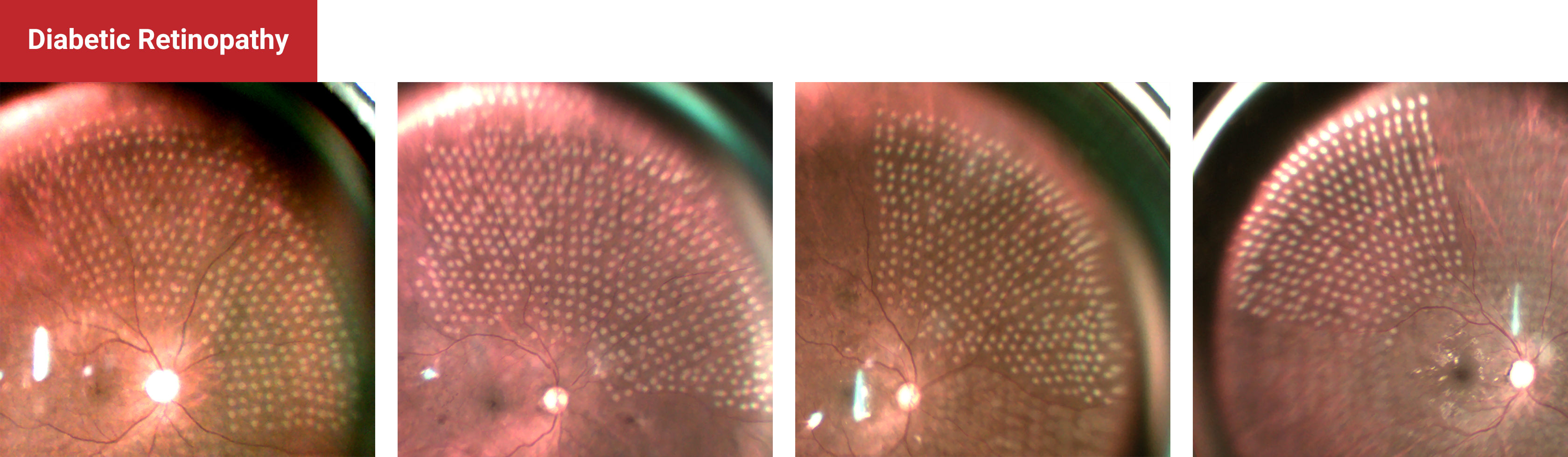 Diabetic Retinopathy