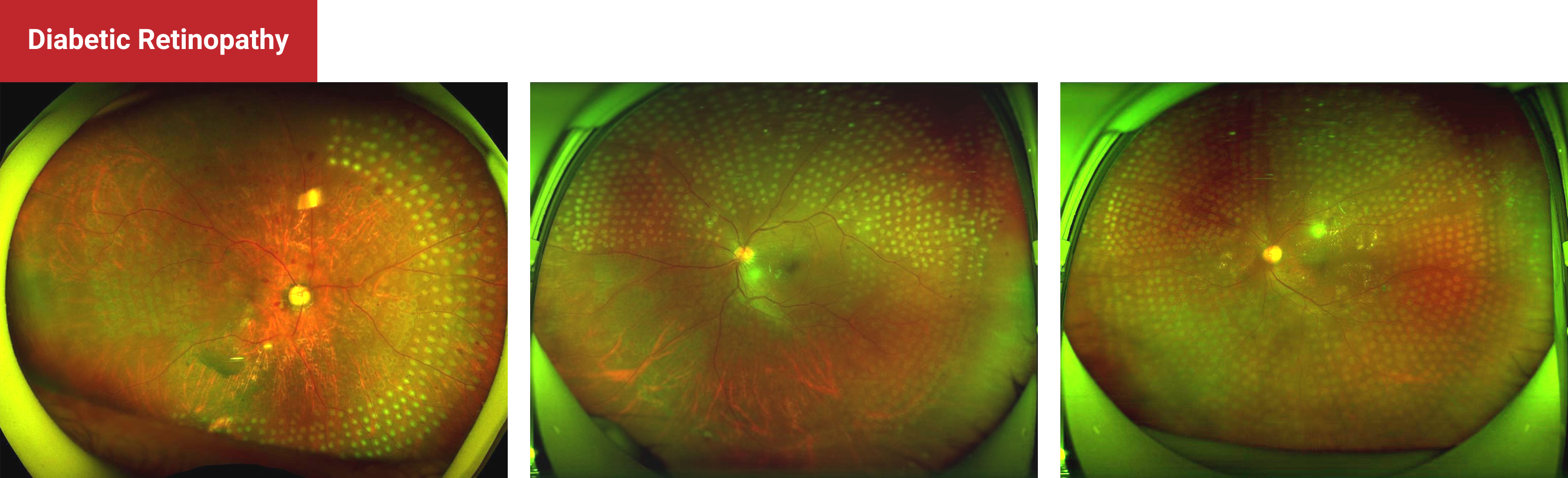 Diabetic Retinopathy