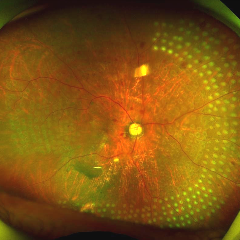 Diabetic Retinopathy