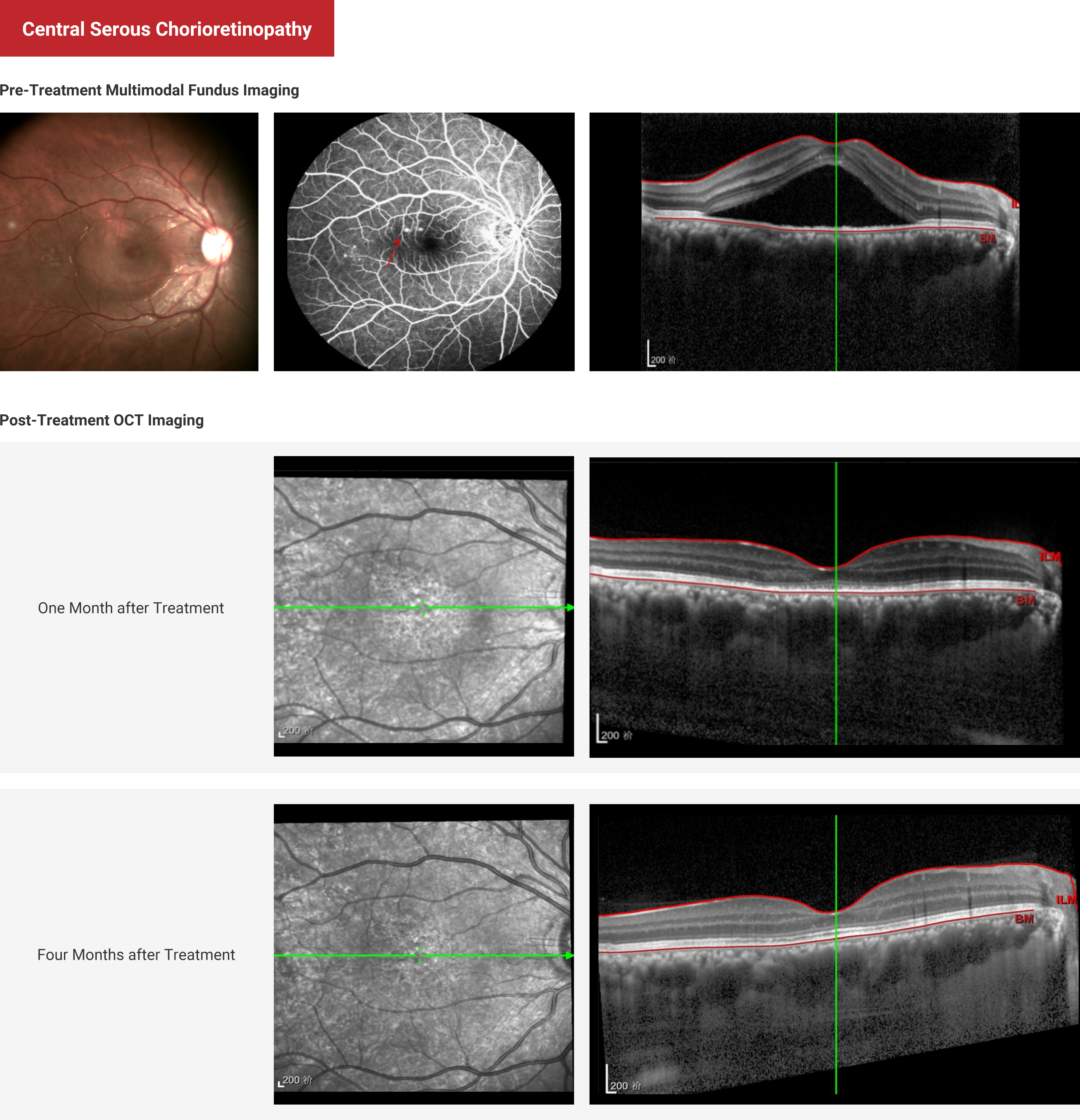 Central Serous Chorioretinopathy
