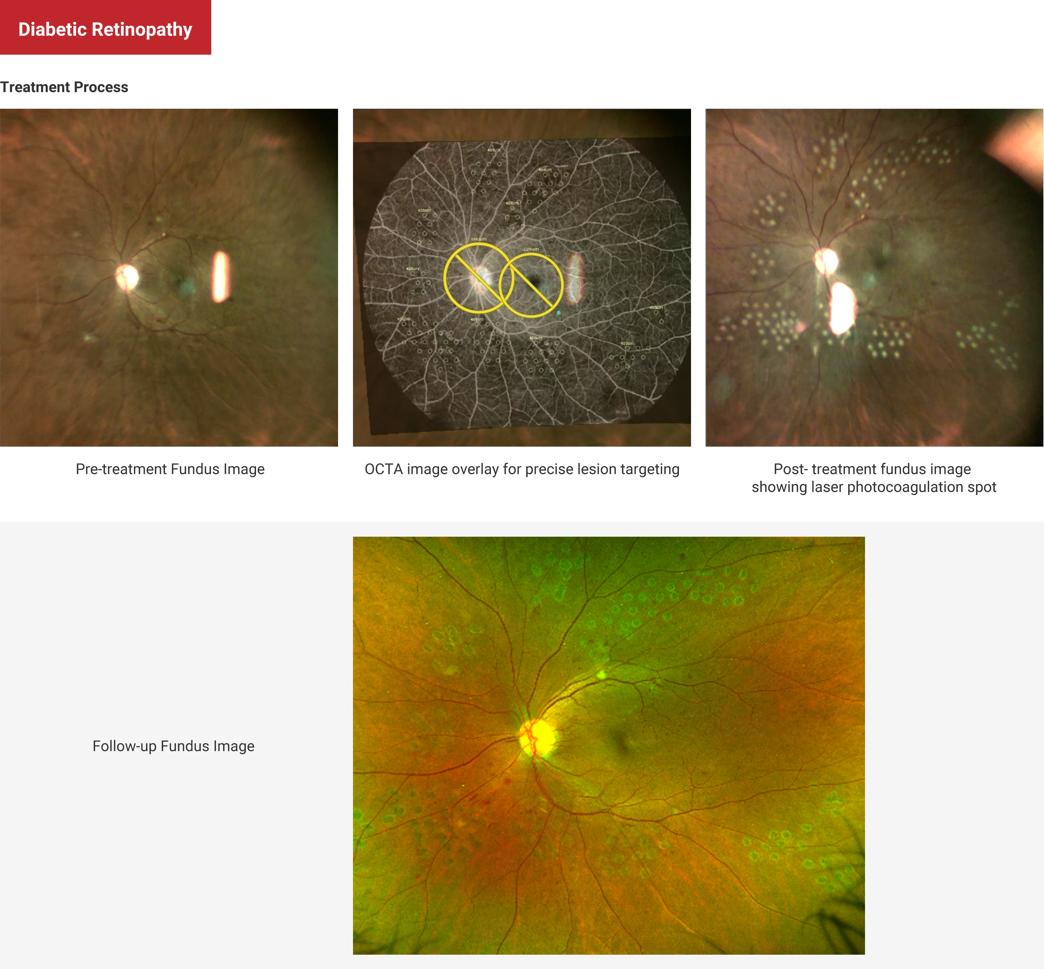 Diabetic Retinopathy