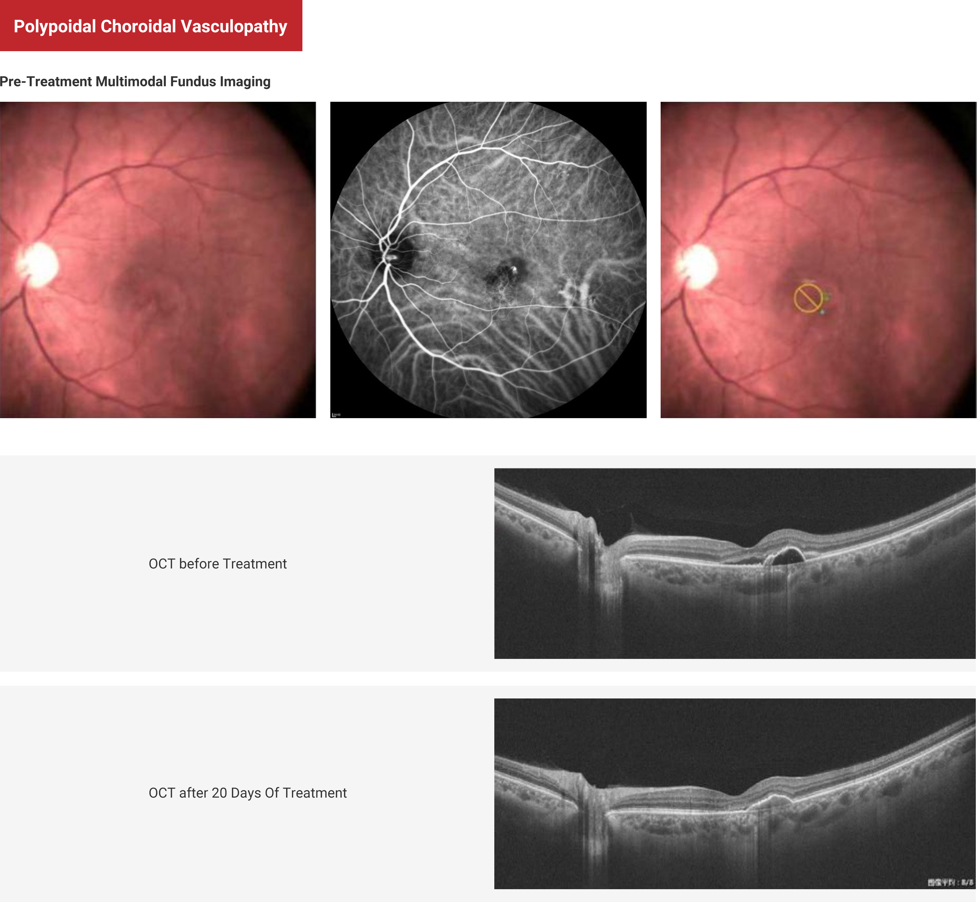Polypoidal Choroidal Vasculopathy