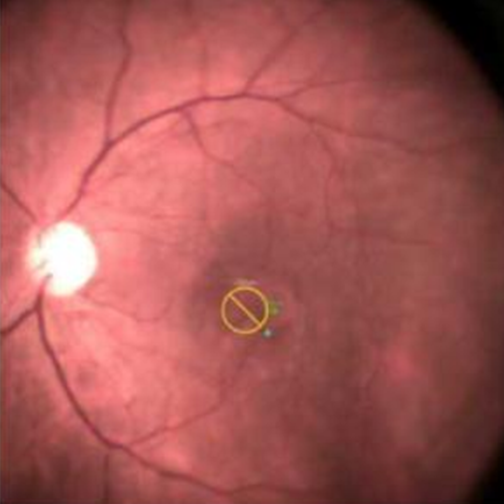 Polypoidal Choroidal Vasculopathy
