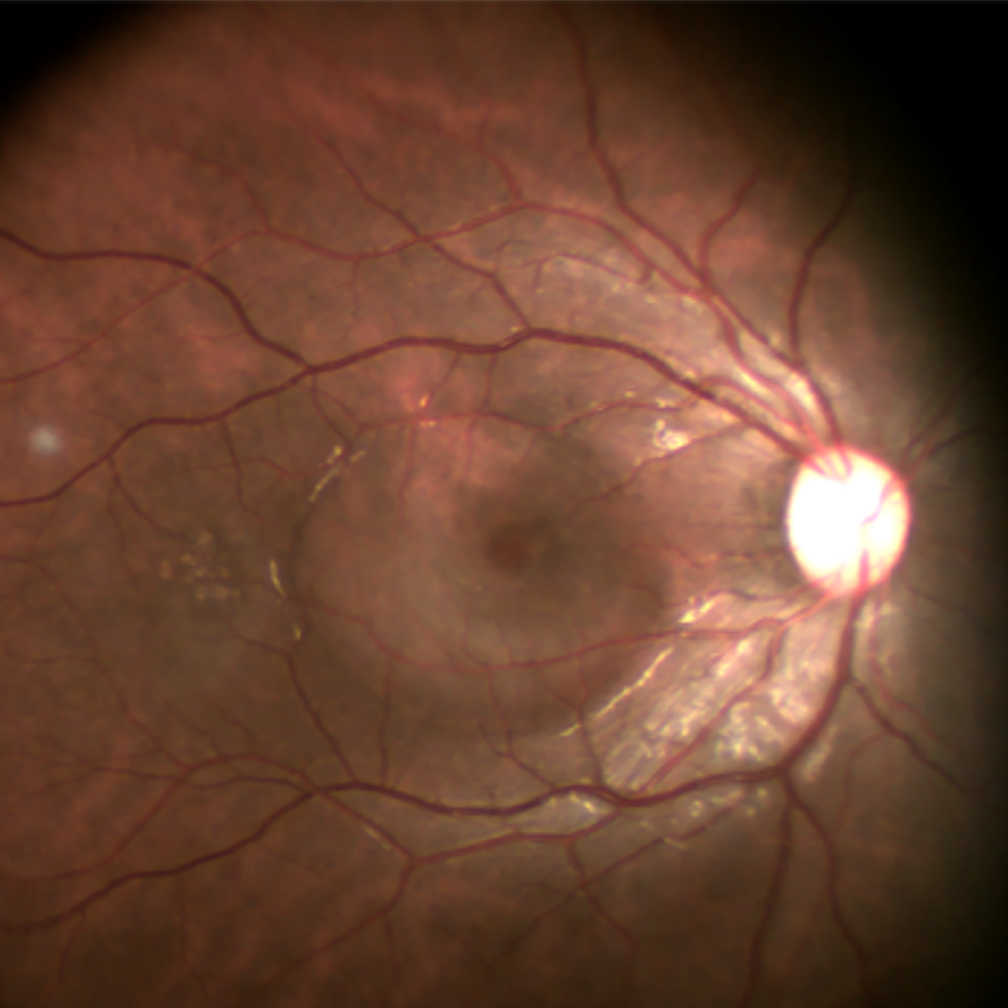 Central Serous Chorioretinopathy