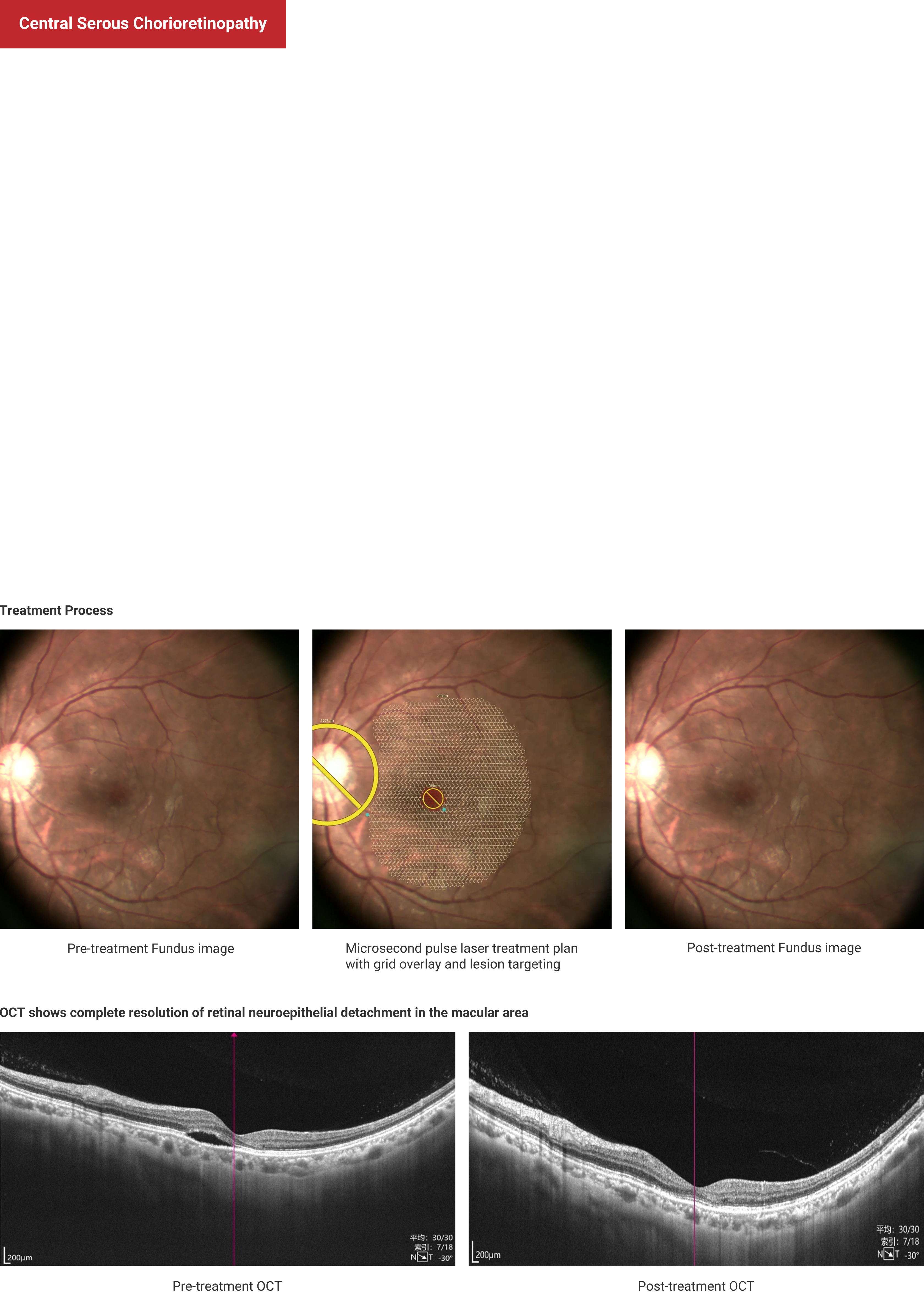 Central Serous Chorioretinopathy