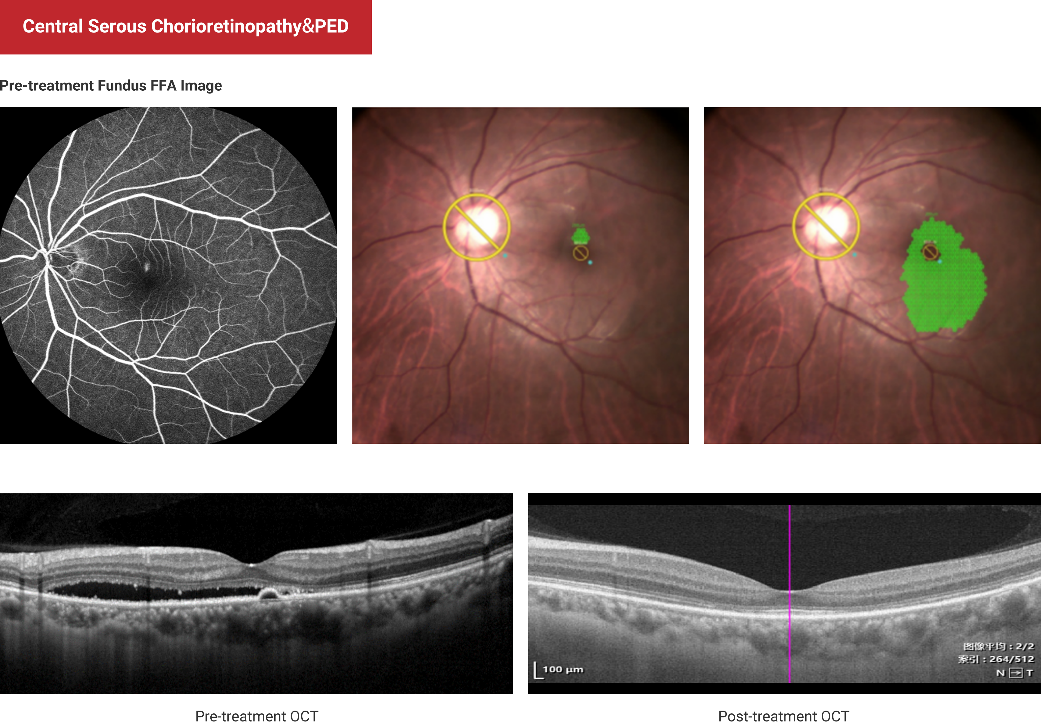 Central Serous Chorioretinopathy&PED