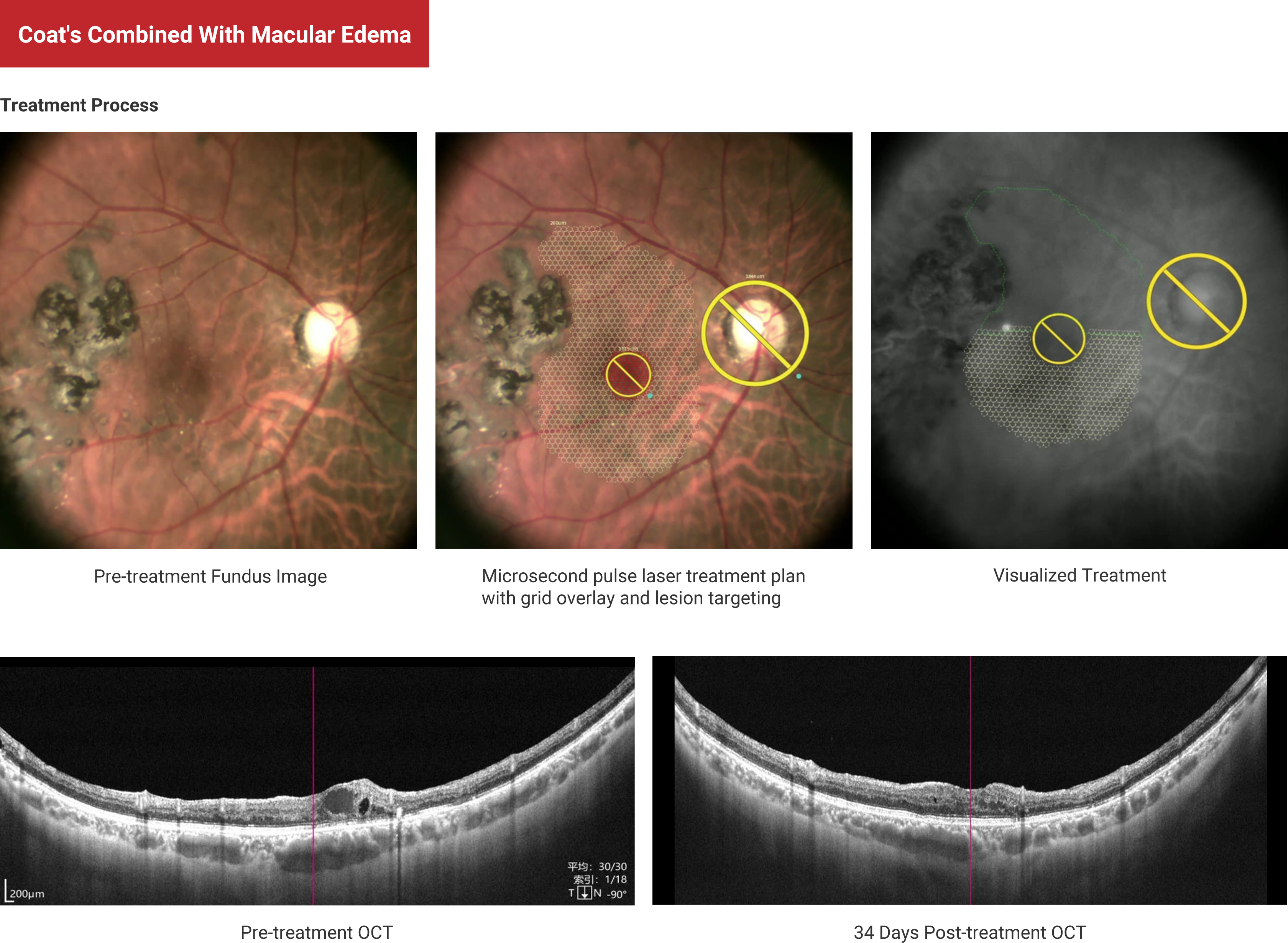 Coat's Combined With Macular Edema