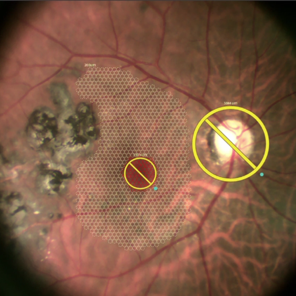 Coat's Combined With Macular Edema