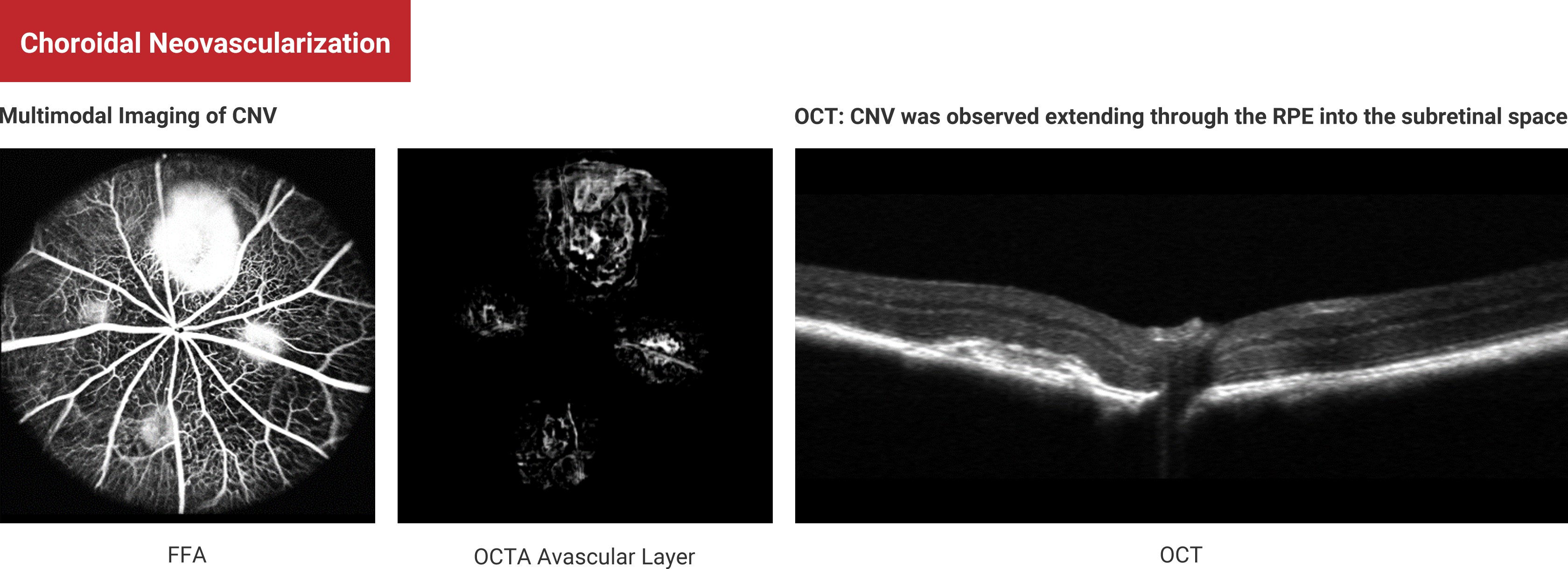 Choroidal Neovascularization