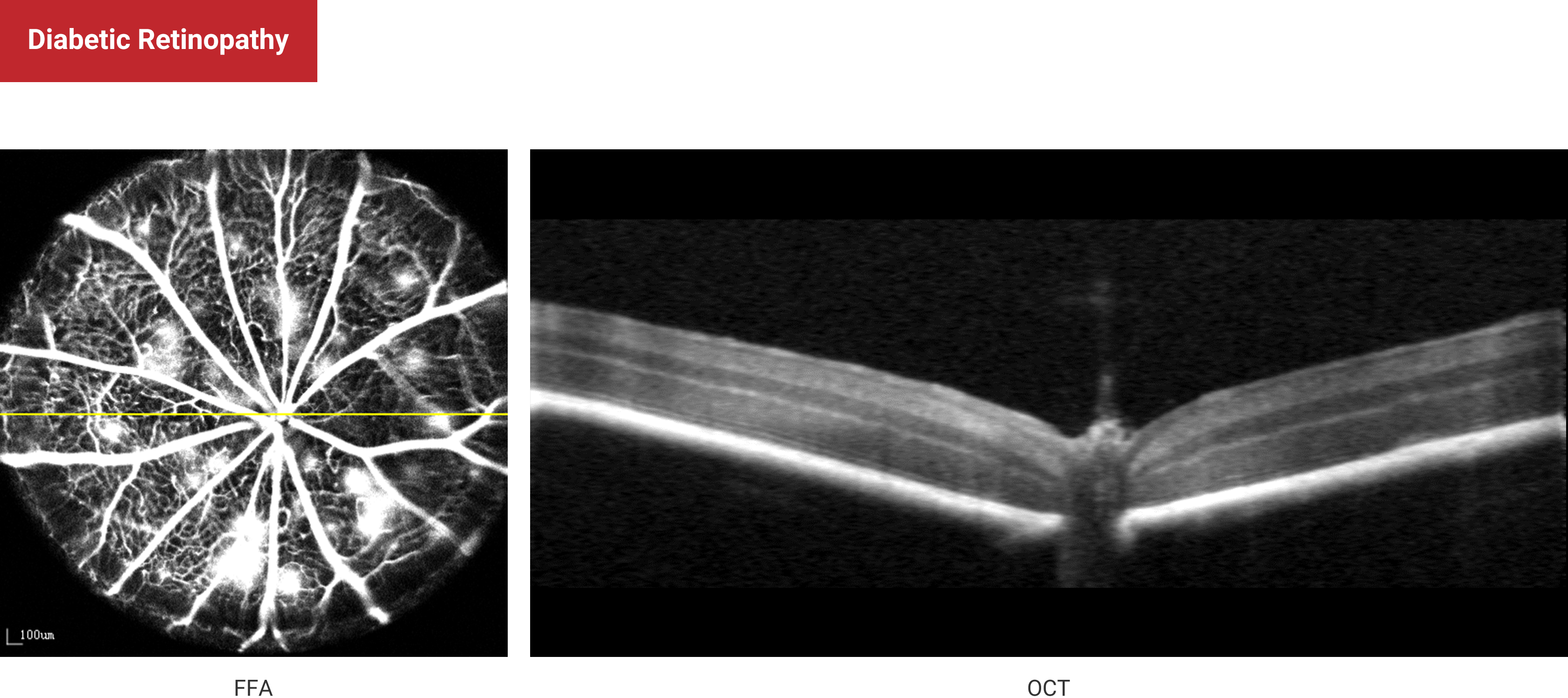 Diabetic Retinopathy
