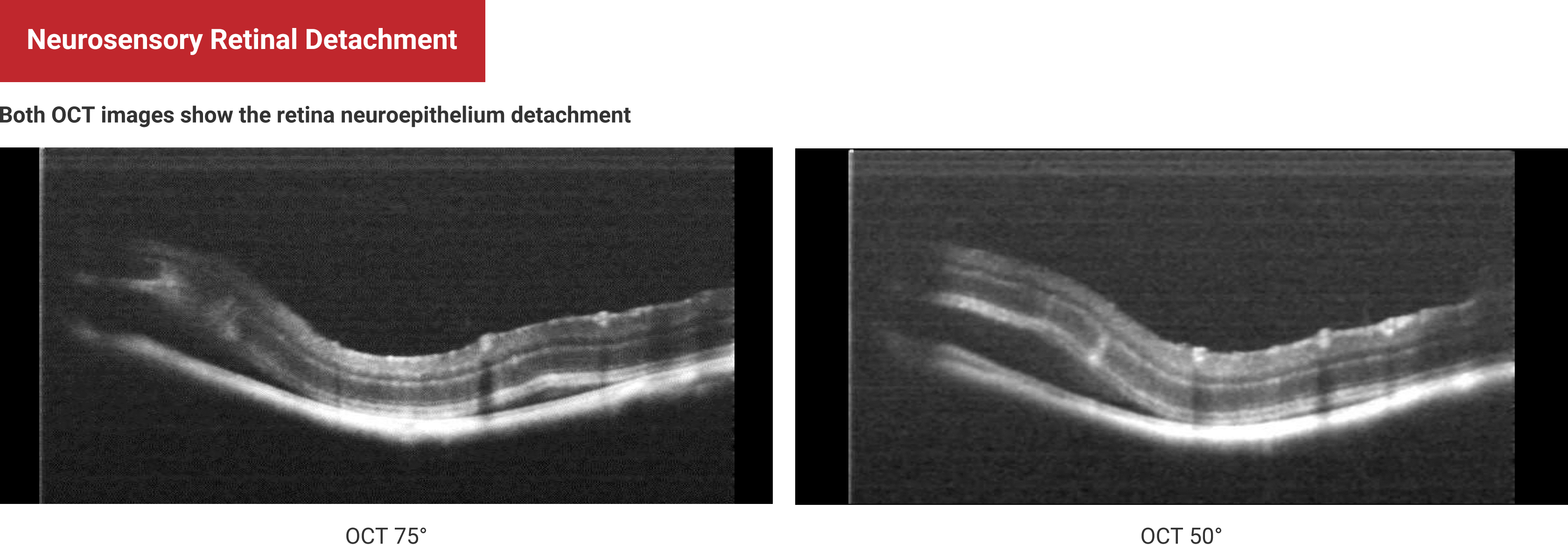 Neurosensory Retinal Detachment