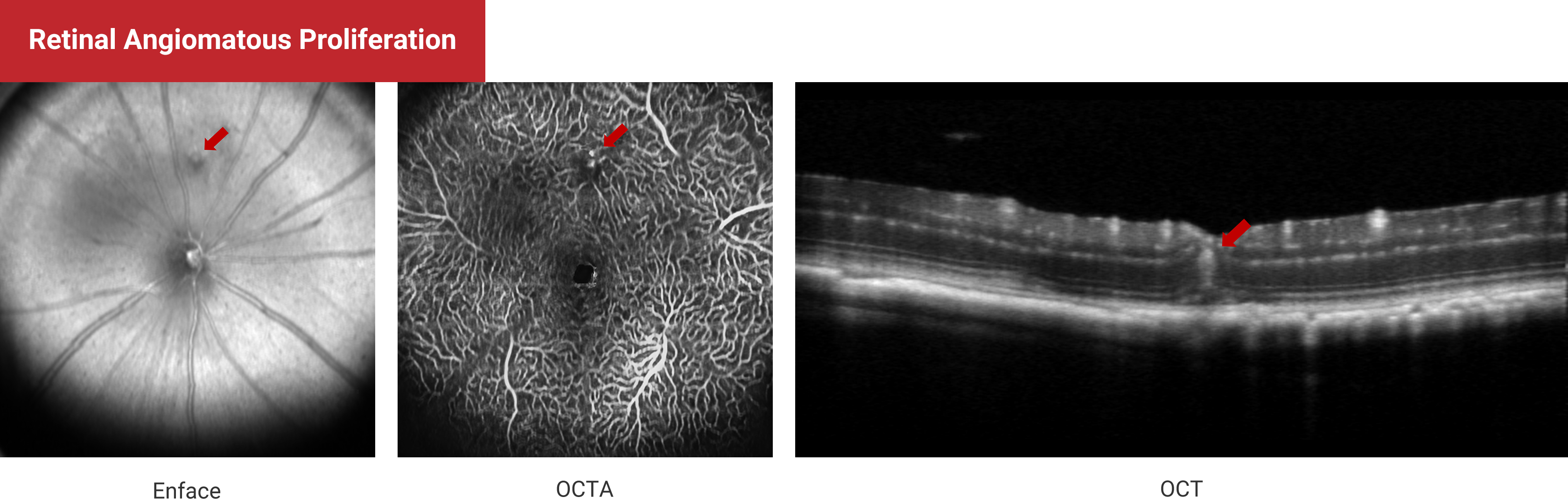 Retinal Angiomatous Proliferation