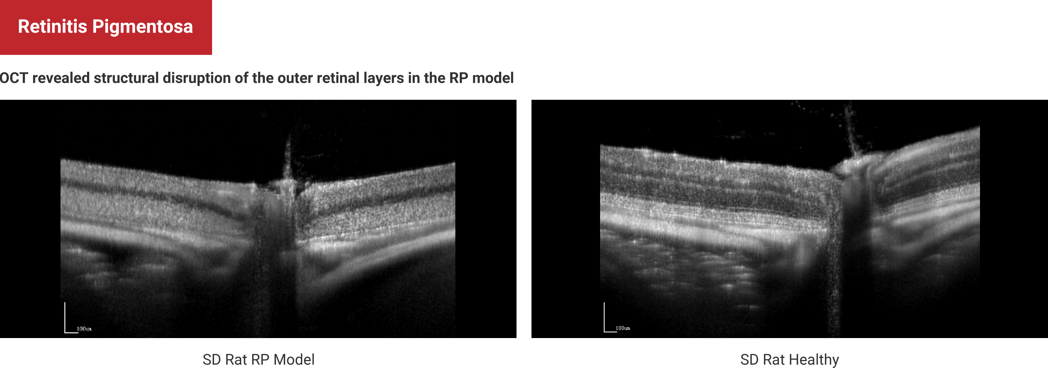 Retinitis Pigmentosa