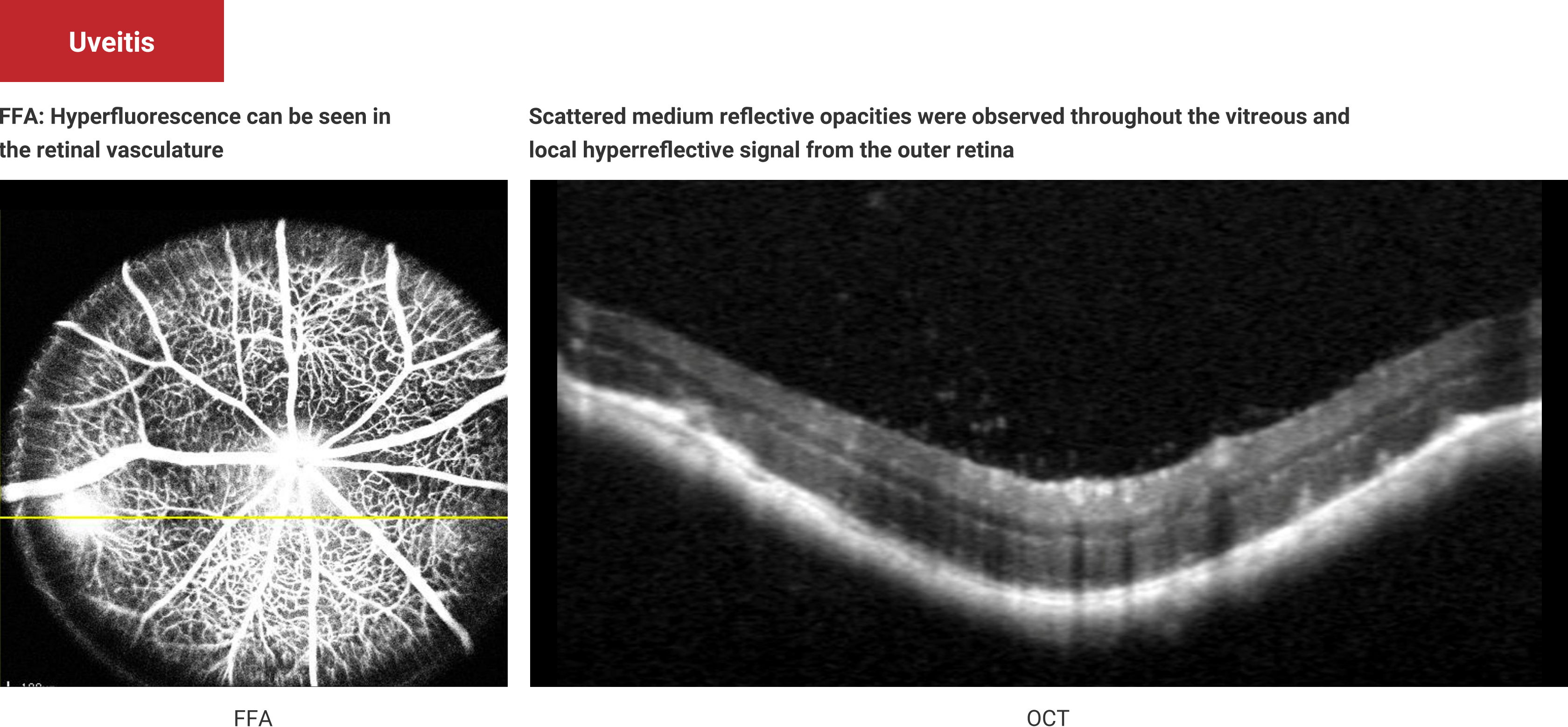 Uveitis