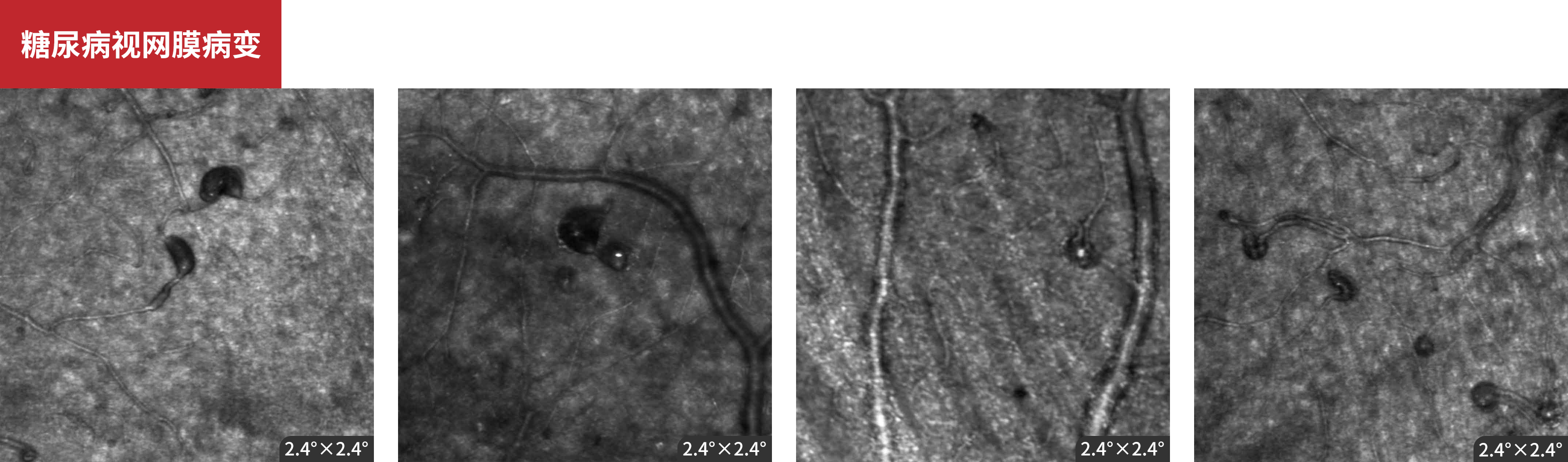 Diabetic Retinopathy