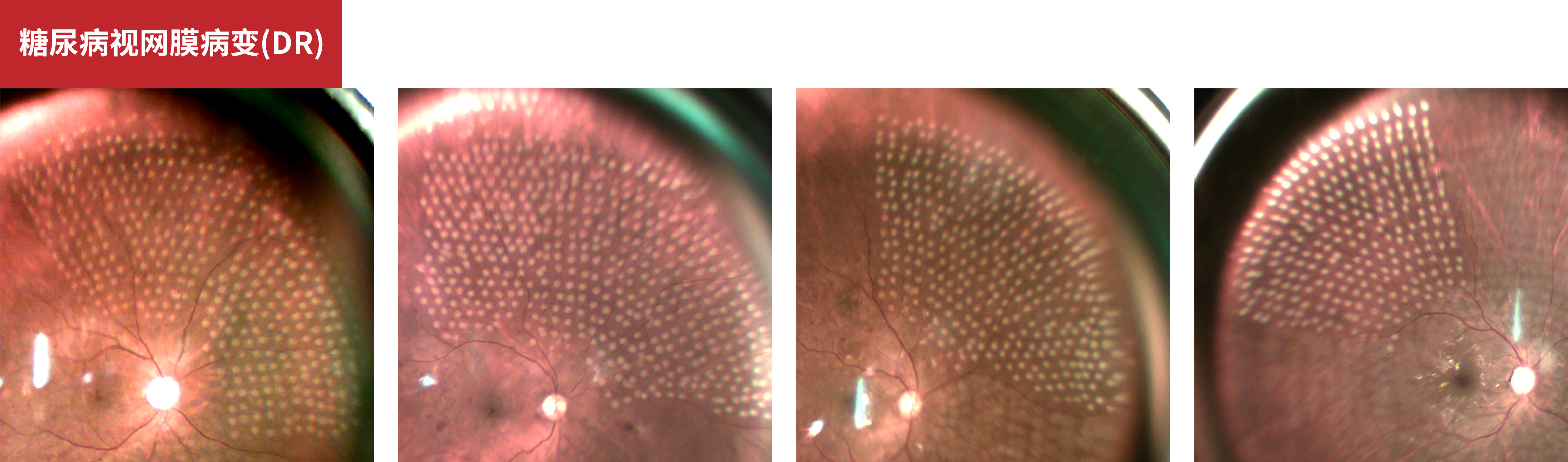 Diabetic Retinopathy