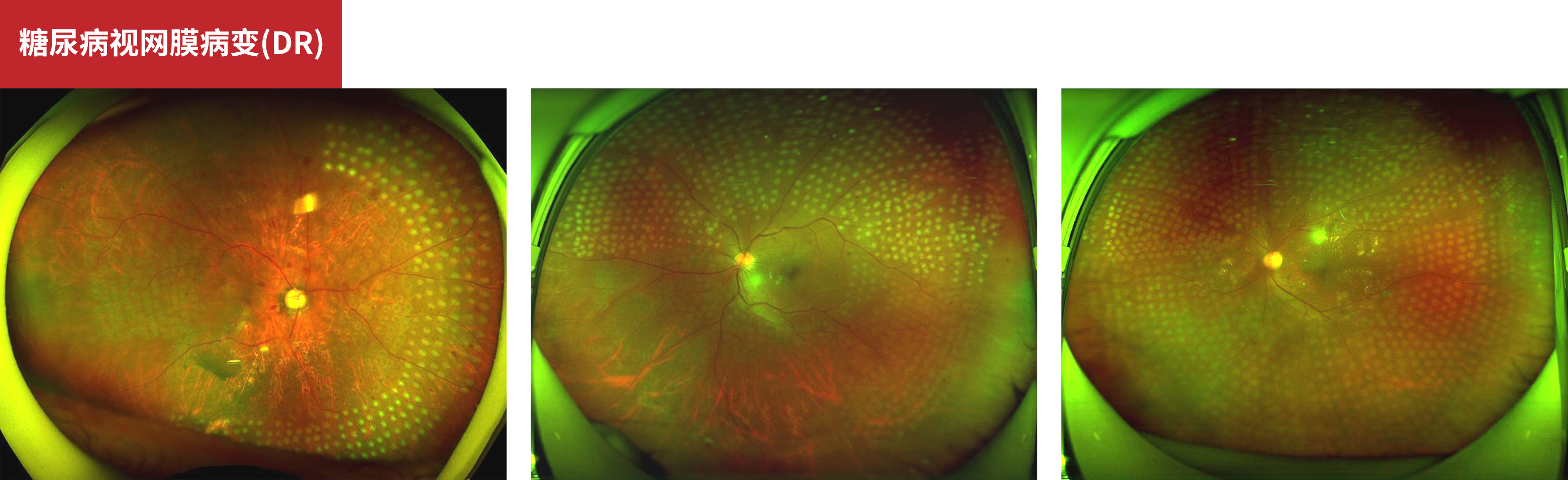 Diabetic Retinopathy