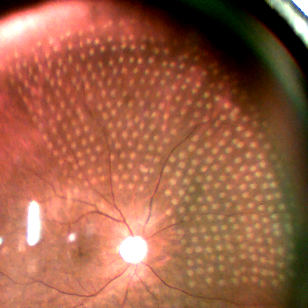 Diabetic Retinopathy
