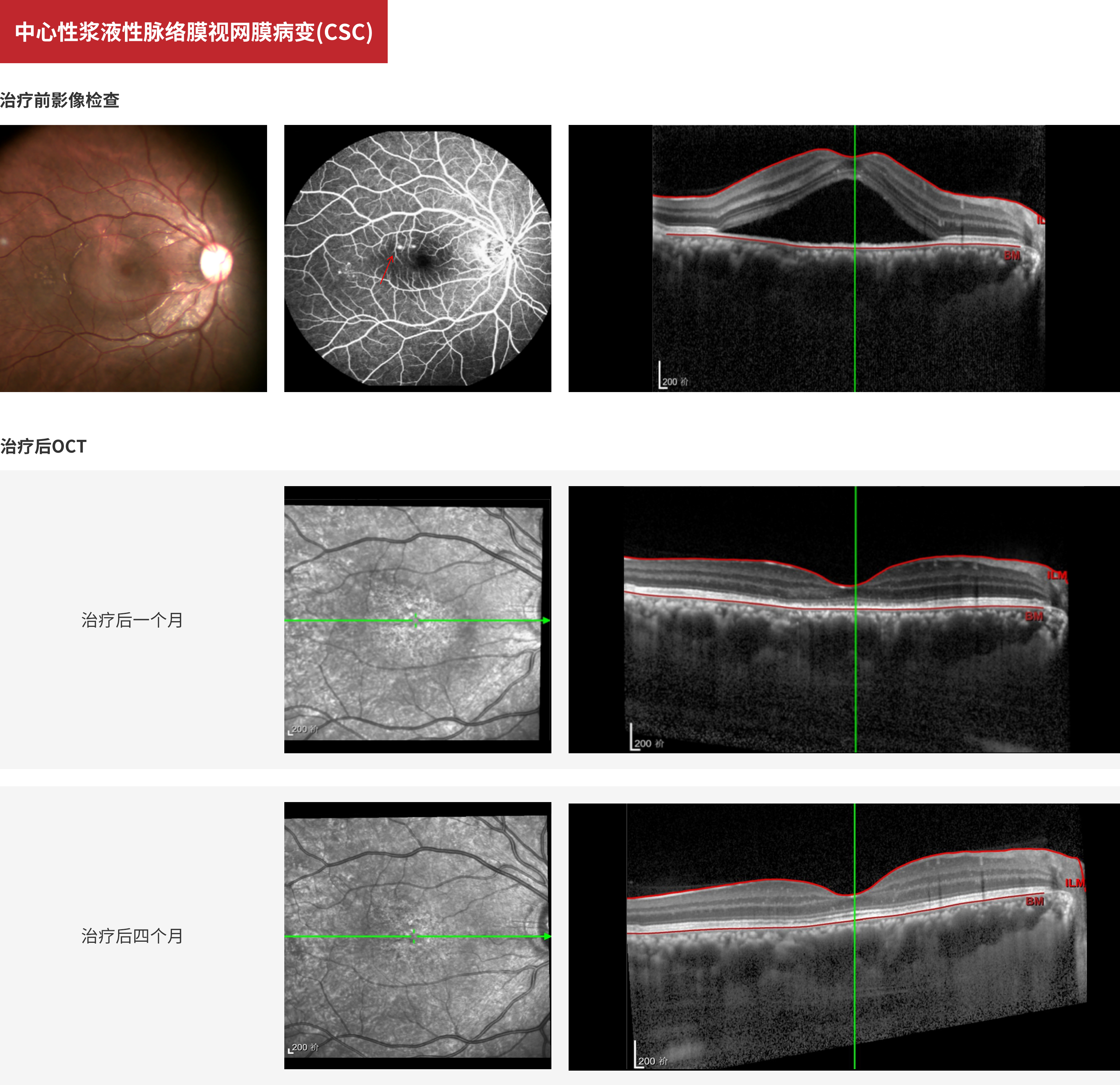 中心性浆液性脉络膜视网膜病变(CSC)