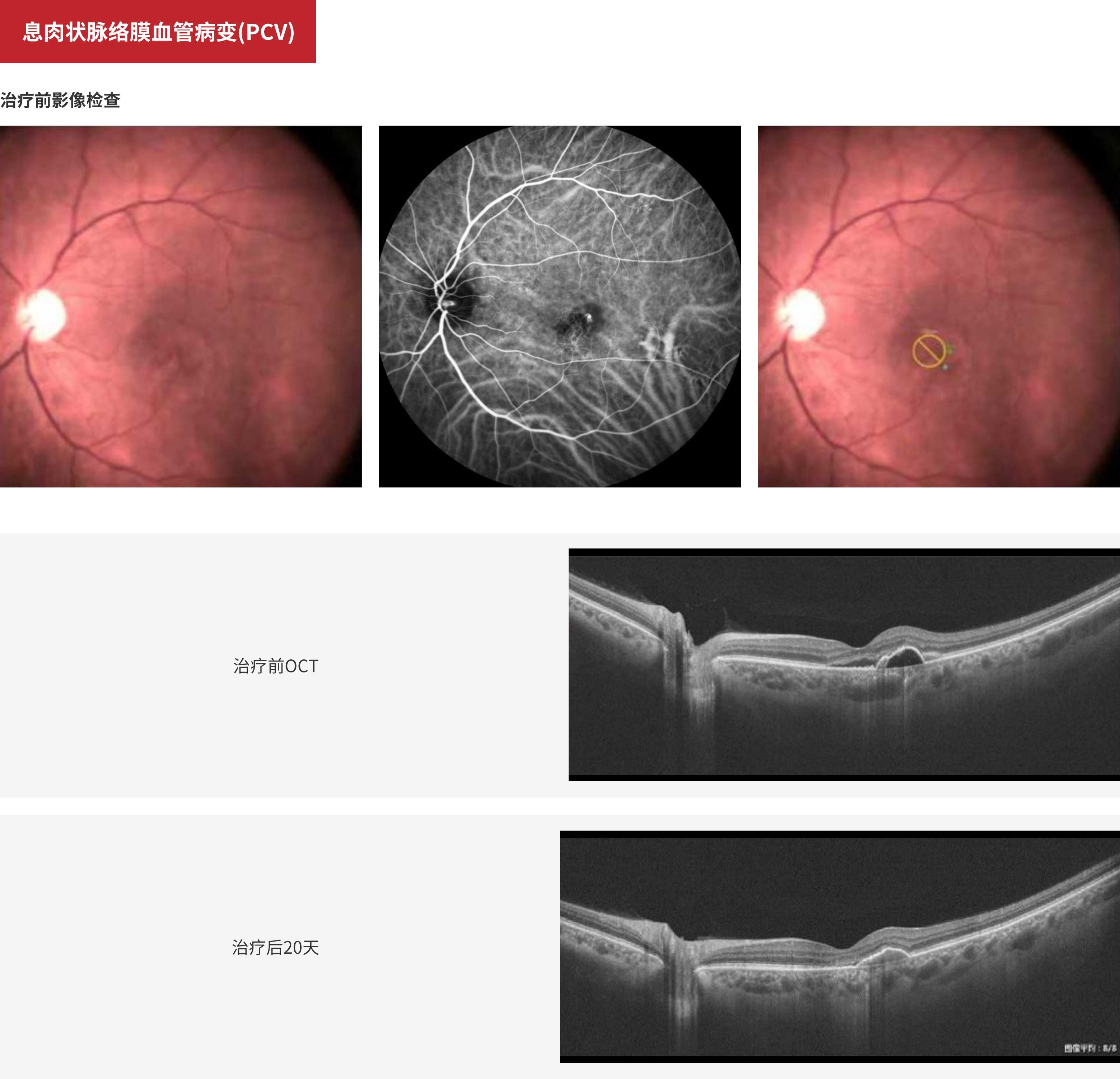 Polypoidal Choroidal Vasculopathy