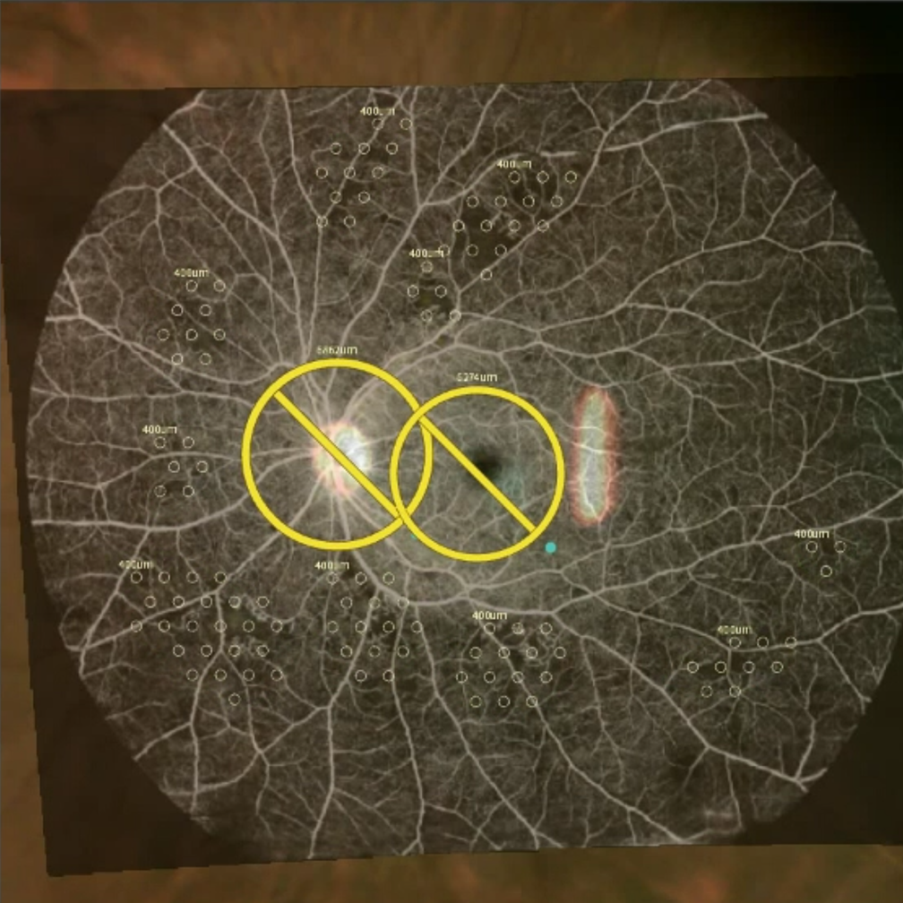 Diabetic Retinopathy 1