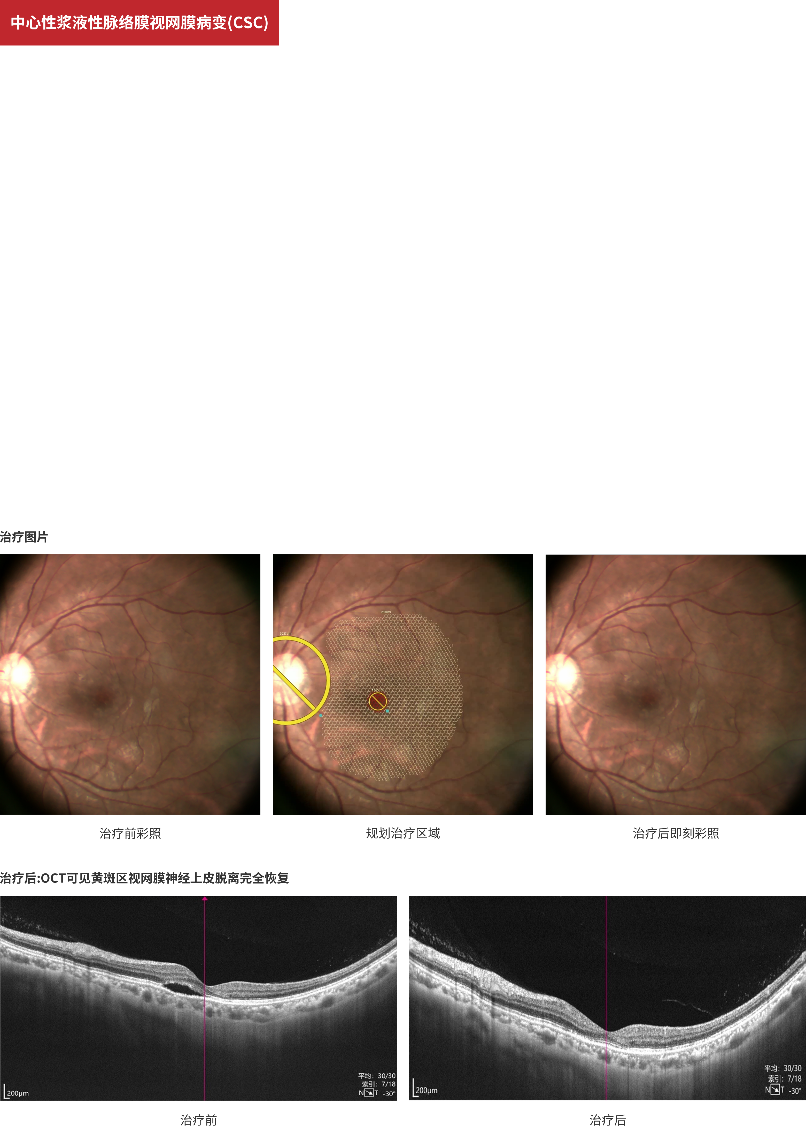 Central Serous Chorioretinopathy