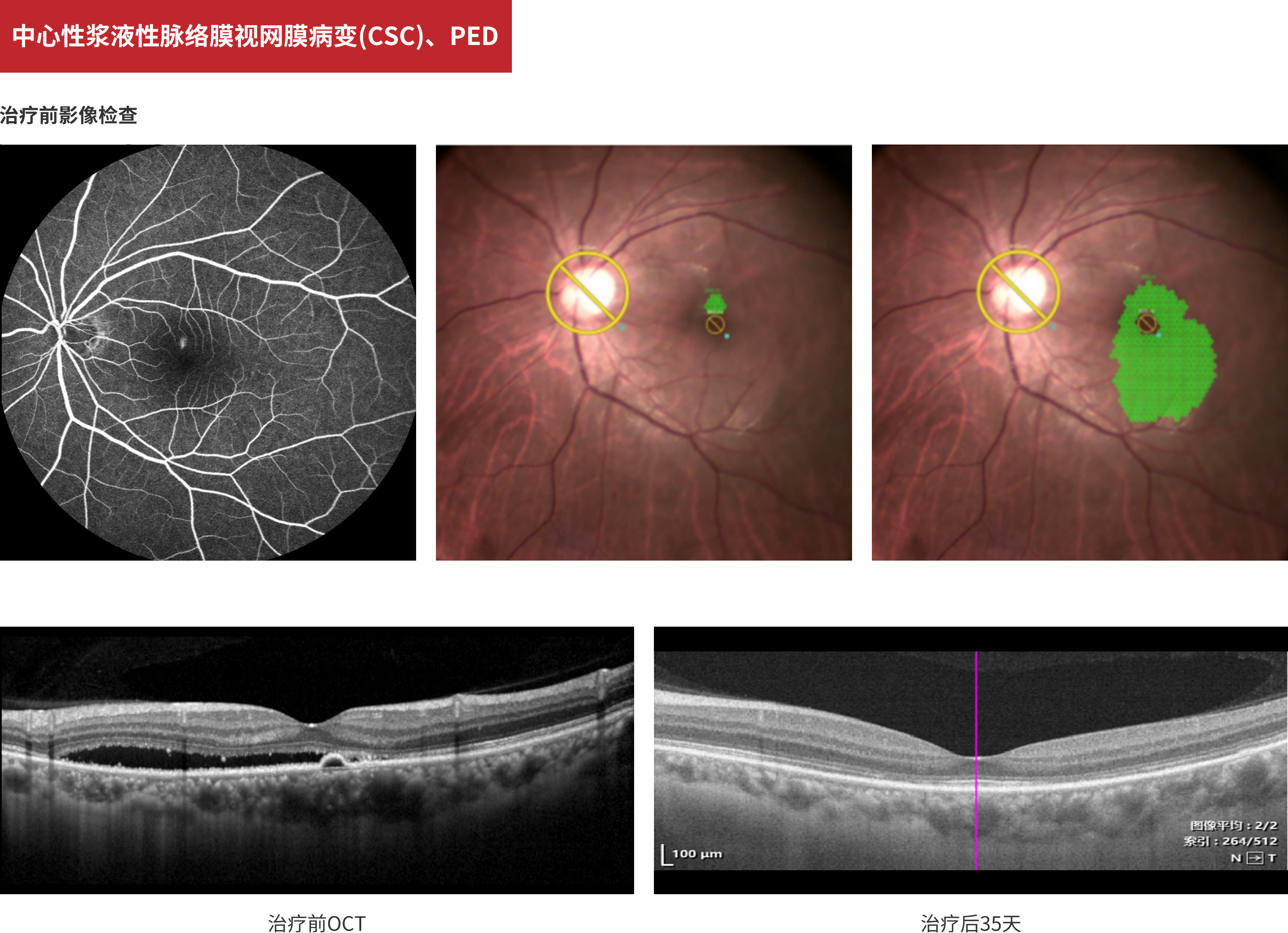 Central Serous Chorioretinopathy&PED