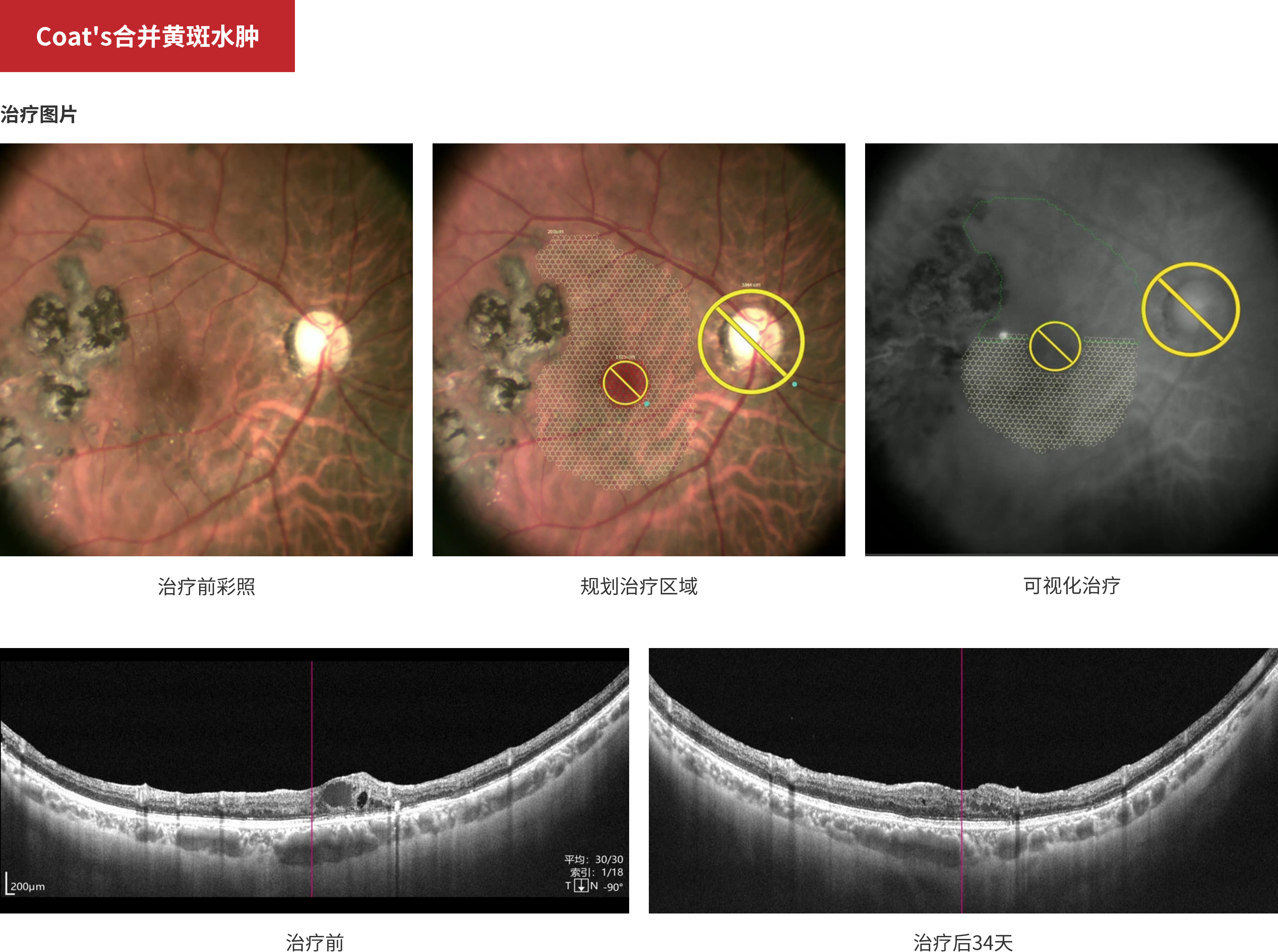 Coat's Combined With Macular Edema
