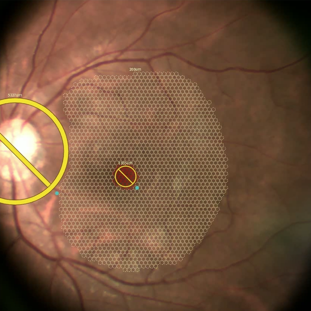 Central Serous Chorioretinopathy 1