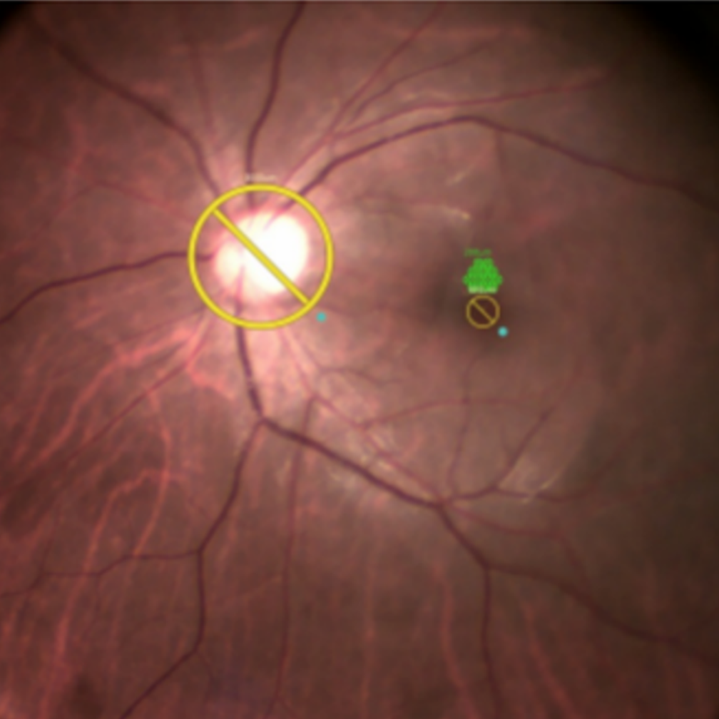 Central Serous Chorioretinopathy&PED