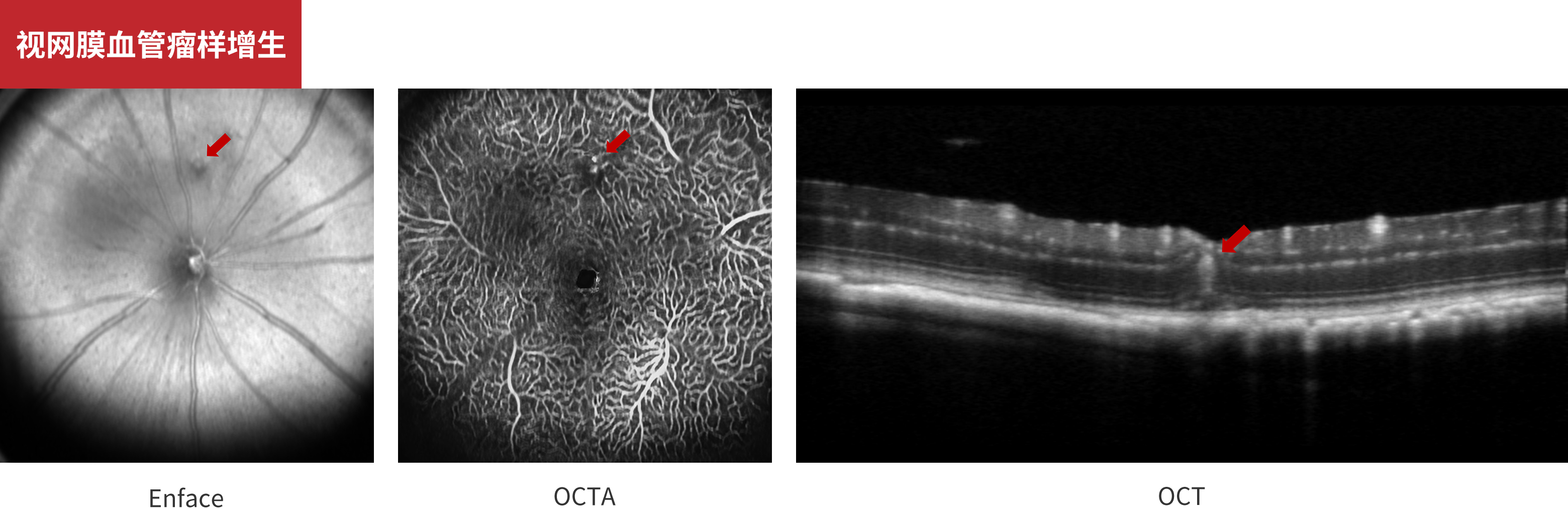 Retinal Angiomatous Proliferation