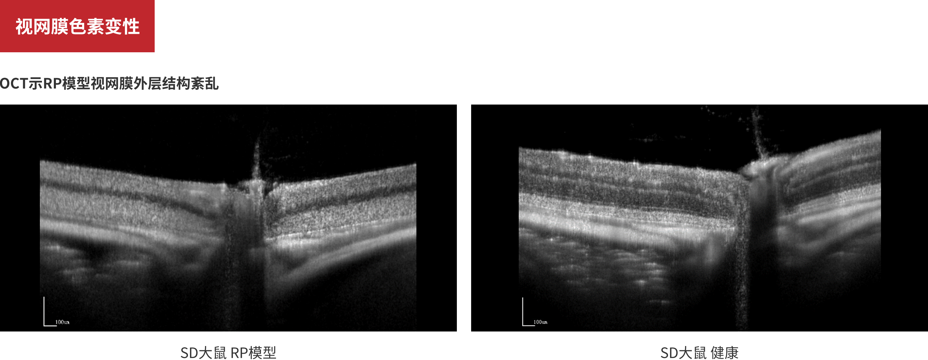 Retinitis Pigmentosa